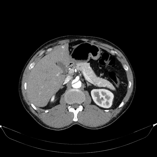 File:Aortic dissection - Stanford type A (Radiopaedia 83418-98500 A 67).jpg