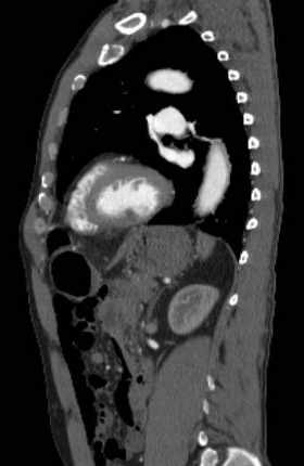File:Aortic dissection - Stanford type B (Radiopaedia 73648-84437 C 54).jpg