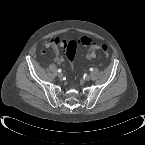 Aortic intramural hematoma (Radiopaedia 34260-35540 B 78).png