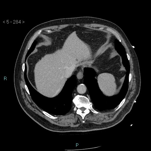 File:Aortic intramural hematoma (Radiopaedia 48463-53380 C 128).jpg