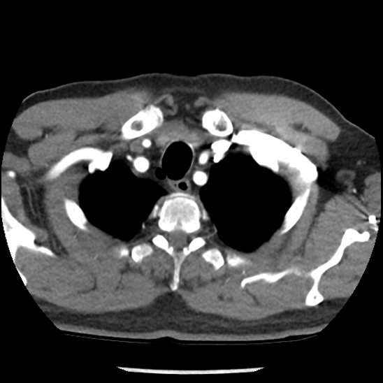 Aortic intramural hematoma (type B) (Radiopaedia 79323-92387 B 4).jpg