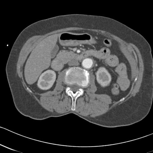 Aortic intramural hematoma from penetrating atherosclerotic ulcer (Radiopaedia 31137-31836 A 104).jpg