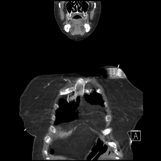 Aortic intramural hematoma with dissection and intramural blood pool (Radiopaedia 77373-89491 C 3).jpg