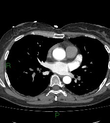 File:Aortic valve endocarditis (Radiopaedia 87209-103485 C 50).jpg