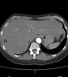 Aortic valve endocarditis (Radiopaedia 87209-103485 C 88).jpg