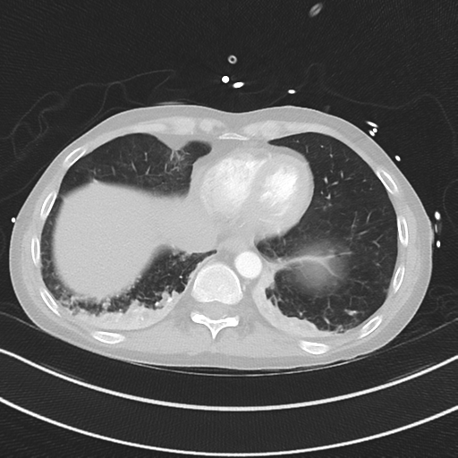 Apical bullous disease in a heavy smoker (Radiopaedia 33067-34092 Axial lung window 48).png