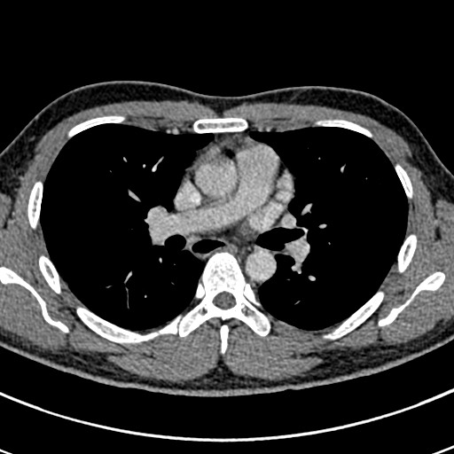 Apical lung mass mimic - neurogenic tumor (Radiopaedia 59918-67521 A 38).jpg