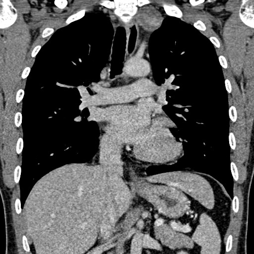 Apical lung mass mimic - neurogenic tumor (Radiopaedia 59918-67521 B 63).jpg