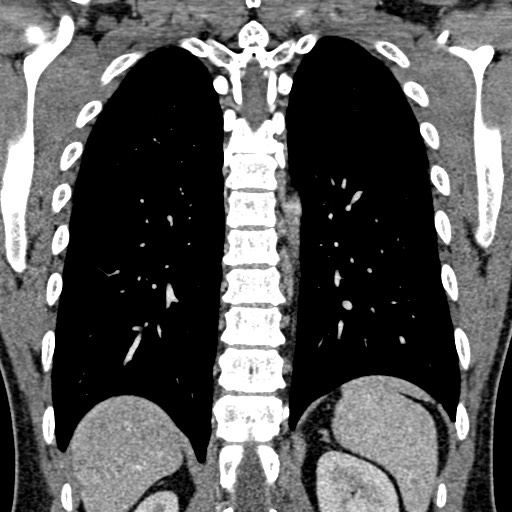 Apical lung mass mimic - neurogenic tumor (Radiopaedia 59918-67521 B 80).jpg