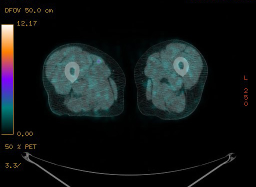 File:Appendiceal adenocarcinoma complicated by retroperitoneal abscess (Radiopaedia 58007-65041 Axial PET-CT 226).jpg