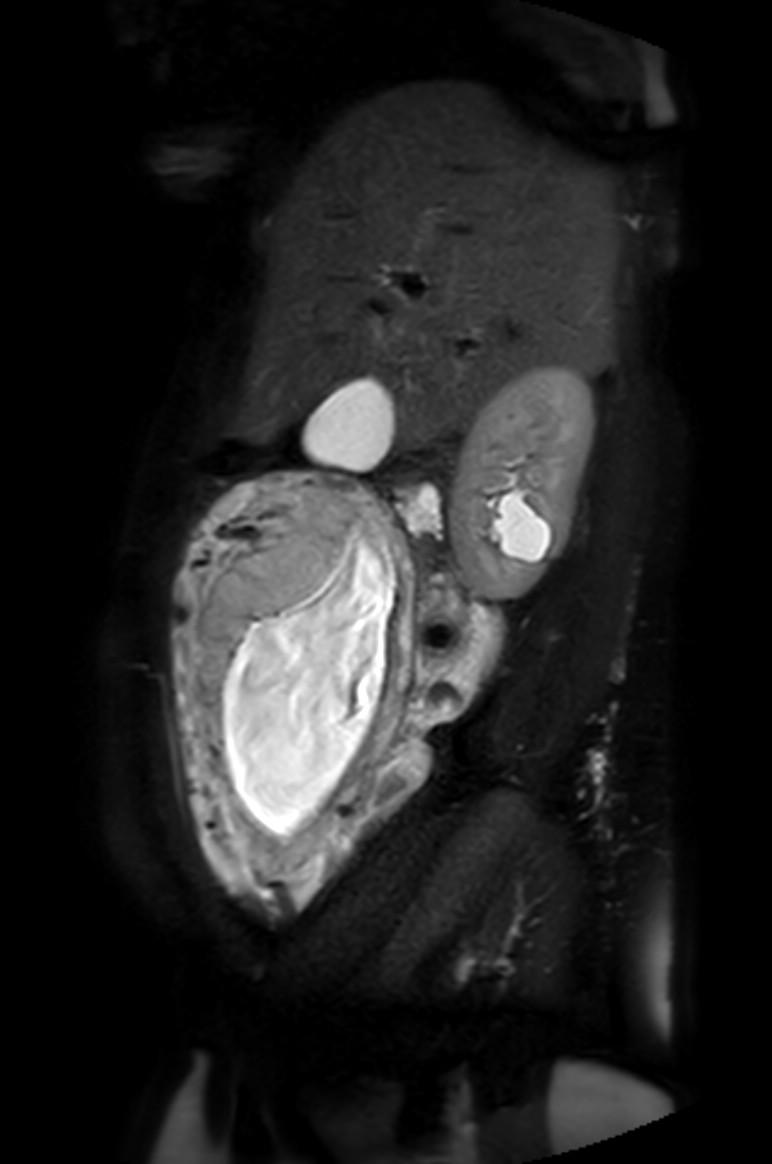 Appendicitis in gravida (MRI) (Radiopaedia 89433-106395 Sagittal T2 SPAIR 46).jpg