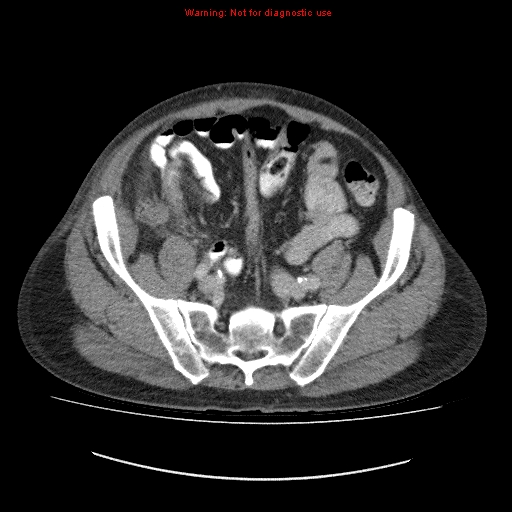 File:Appendicitis mass in inguinal hernia (Radiopaedia 26858-27029 A 10).jpg