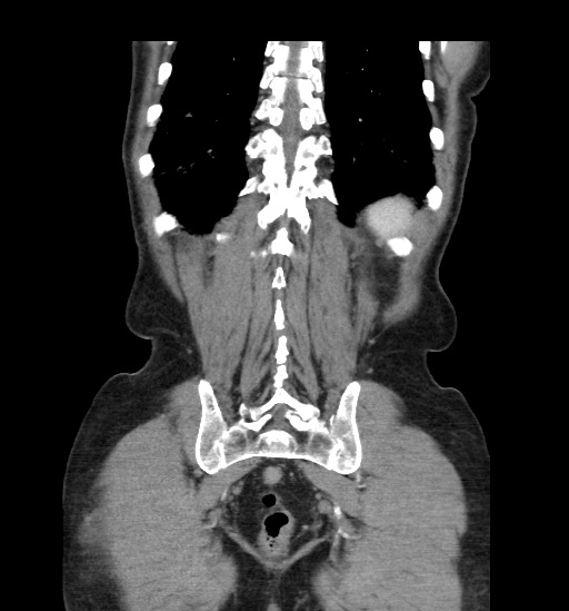 Appendicitis with localized perforation and abscess formation (Radiopaedia 49035-54130 B 42).jpg