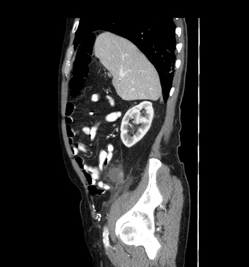File:Appendicitis with localized perforation and abscess formation (Radiopaedia 49035-54130 C 17).jpg