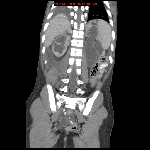 Appendicitis with phlegmon (Radiopaedia 9358-10046 B 53).jpg