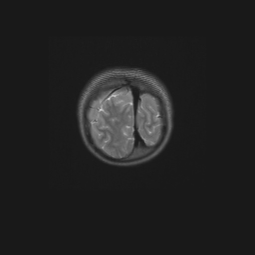 Aqueduct stenosis (Radiopaedia 52453-58460 Coronal T2 4).jpg