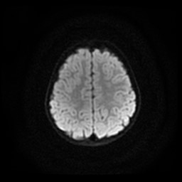Arachnoid cyst - middle cranial fossa (Radiopaedia 86780-102938 Axial DWI 7).jpg