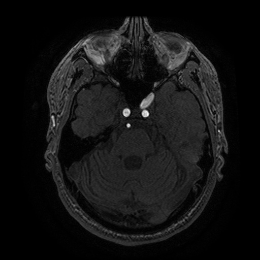 Arteriovenous malformation (Radiopaedia 71628-81999 Axial MRA 84).jpg