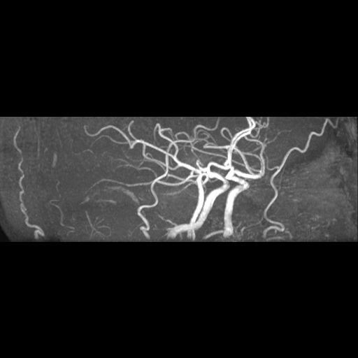 Artery of Percheron infarction (Radiopaedia 27975-28230 3D TOF 17).jpg