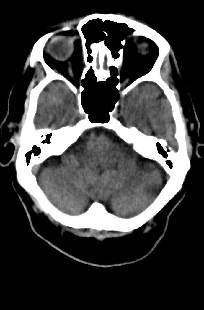 Artery of Percheron infarction (Radiopaedia 80613-94202 Axial non-contrast 53).jpg