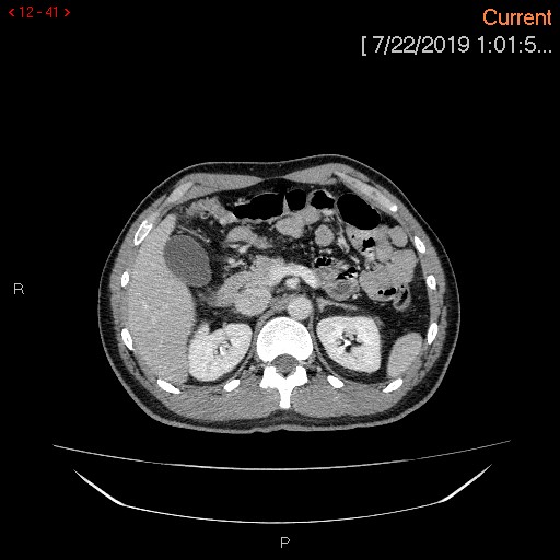 File:Ascending colonic diverticulum mimicking acute appendicitis (Radiopaedia 69943-80198 A 41).jpg