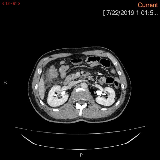 Ascending colonic diverticulum mimicking acute appendicitis (Radiopaedia 69943-80198 A 61).jpg