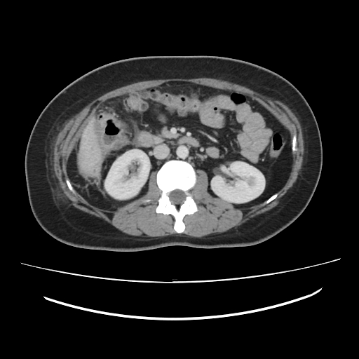 File:Ascending retrocecal appendicitis with liver abscesses (Radiopaedia 60066-67615 B 42).jpg