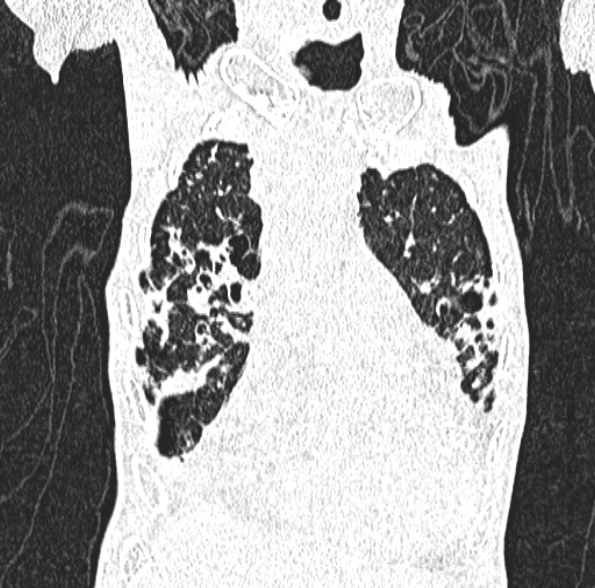 File:Aspergilloma- with Monod sign (Radiopaedia 44737-48532 Coronal lung window 161).jpg