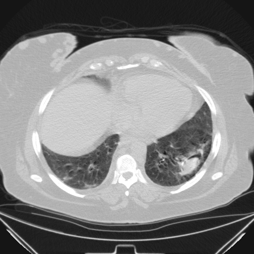 Aspergilloma (Radiopaedia 39611-41932 Axial lung window 95).jpg