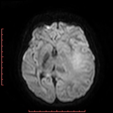 Astroblastoma (Radiopaedia 74287-85162 Axial DWI 54).jpg