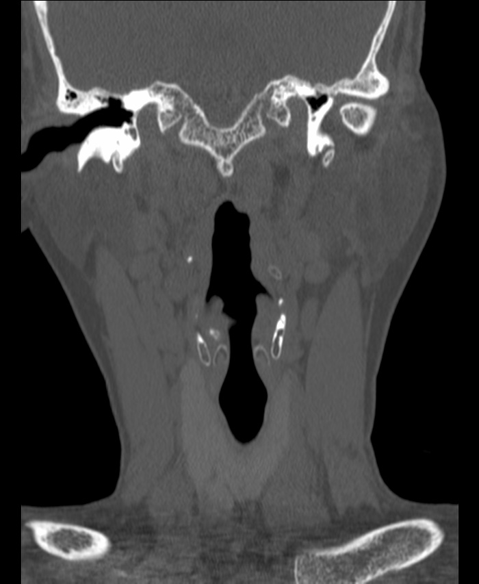 Atlanto-occipital assimilation with basilar invagination (Radiopaedia 70122-80188 Coronal bone window 29).jpg