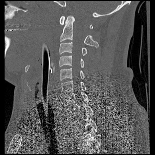 Atlanto-occipital dissociation injury (Radiopaedia 29274-29698 Sagittal bone window 28).png