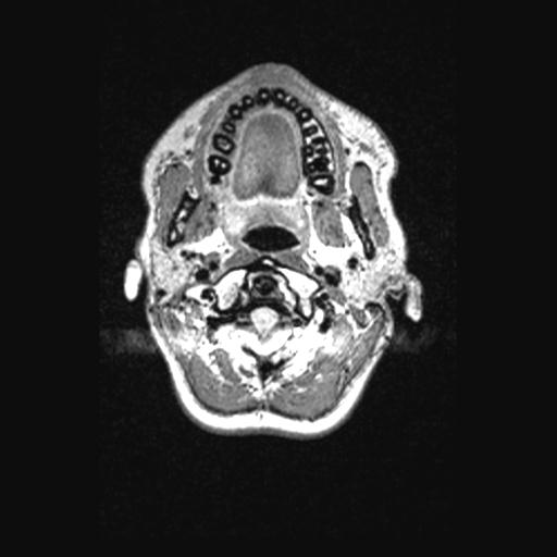 Atretic encephalocoele with inferior vermis hypoplasia (Radiopaedia 30443-31108 Axial 13).jpg