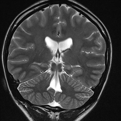File:Atretic encephalocoele with inferior vermis hypoplasia (Radiopaedia 30443-31108 Coronal T2 1).jpg