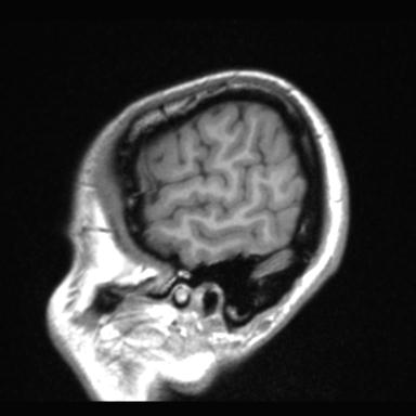 Atretic encephalocoele with inferior vermis hypoplasia (Radiopaedia 30443-31108 Sagittal T1 120).jpg