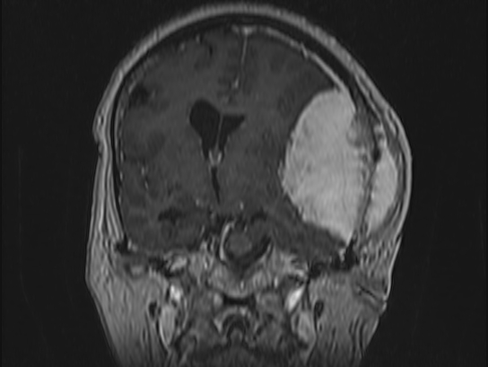 Atypical meningioma (Radiopaedia 62985-71406 Coronal T1 C+ 55).jpg