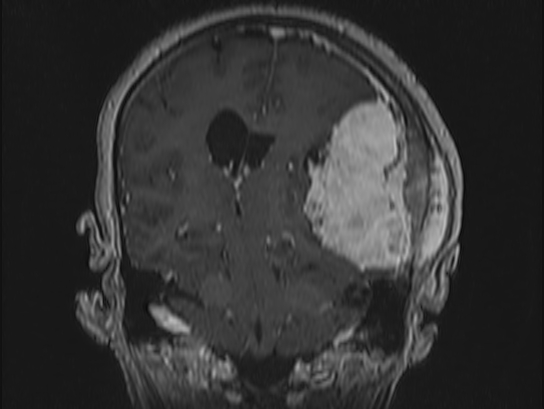 Atypical meningioma (Radiopaedia 62985-71406 Coronal T1 C+ 74).jpg