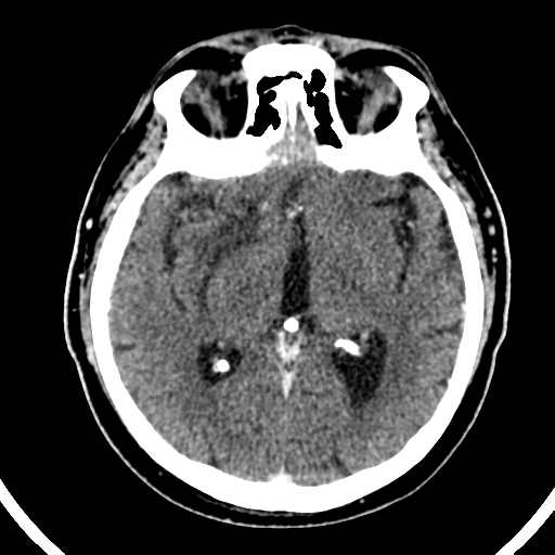 Atypical meningioma (WHO grade II) with brain invasion (Radiopaedia 57767-64728 Axial C+ 31).png