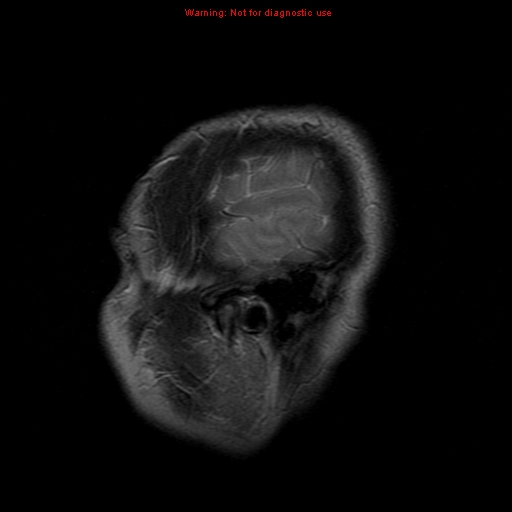 File:Atypical meningioma - grade II (Radiopaedia 13303-13305 Sagittal T2 2).jpg
