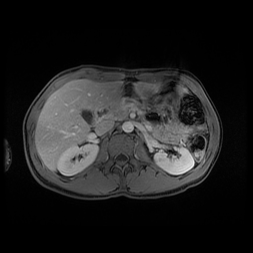 Autoimmune pancreatitis (Radiopaedia 69751-79729 M 64).jpg