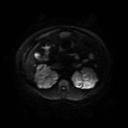 File:Autosomal dominant polycystic kidney disease (Radiopaedia 50259-55611 Axial DWI 56).jpg