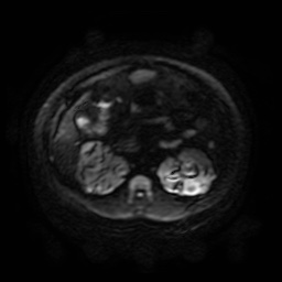 Autosomal dominant polycystic kidney disease (Radiopaedia 50259-55611 Axial DWI 92).jpg
