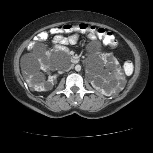 Autosomal dominant polycystic kidney disease with hepatic involvement (Radiopaedia 32693-33662 B 36).jpg