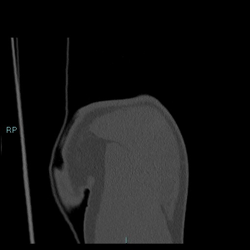 Avascular necrosis after fracture dislocations of the proximal humerus (Radiopaedia 88078-104655 Coronal bone window 30).jpg
