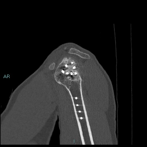Avascular necrosis after fracture dislocations of the proximal humerus (Radiopaedia 88078-104655 Sagittal bone window 21).jpg