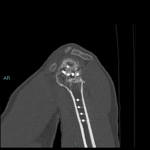 File:Avascular necrosis after fracture dislocations of the proximal humerus (Radiopaedia 88078-104655 Sagittal bone window 22).jpg