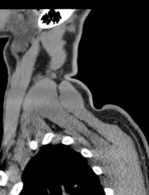Axis peg fracture (type 3) and atlas lateral mass (type 4) fracture (Radiopaedia 37474-39324 D 74).png