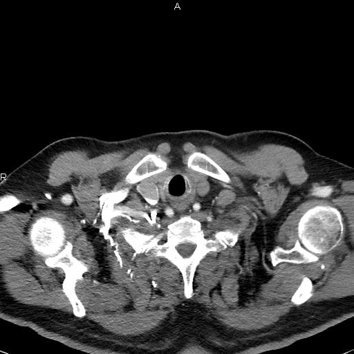Azygos continuation of the inferior vena cava (Radiopaedia 18537-18404 C+ arterial phase 5).jpg