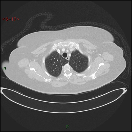 File:Azygos fissure and lobe (Radiopaedia 47620-52278 Axial lung window 17).jpg