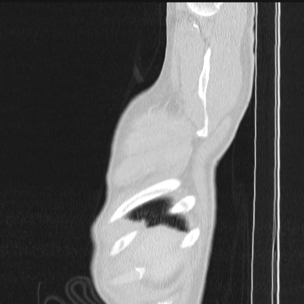 Azygos lobe (Radiopaedia 38259-40275 lung window 8).jpg